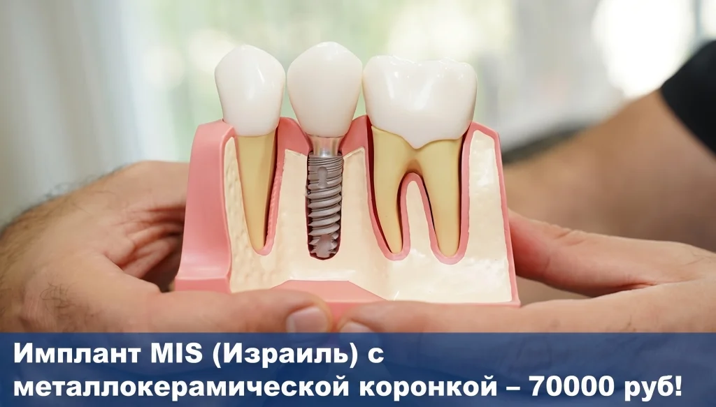 Имплант MIS (Израиль) c коронкой — 70 000 руб!